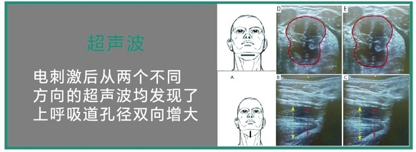 超声波证据